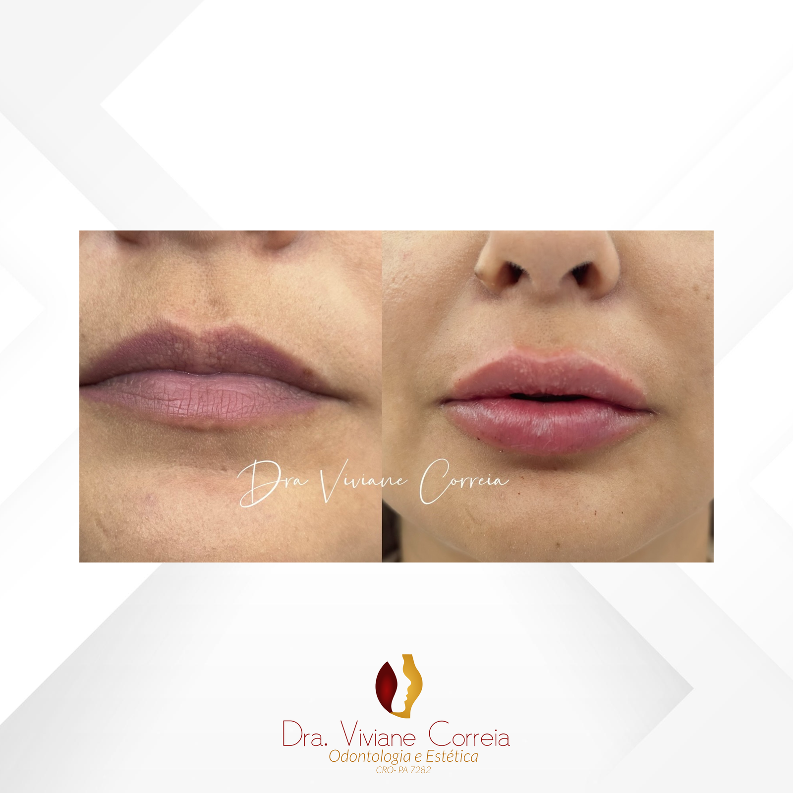 Dra. Viviane Correia Preenchimento Labial #1.1