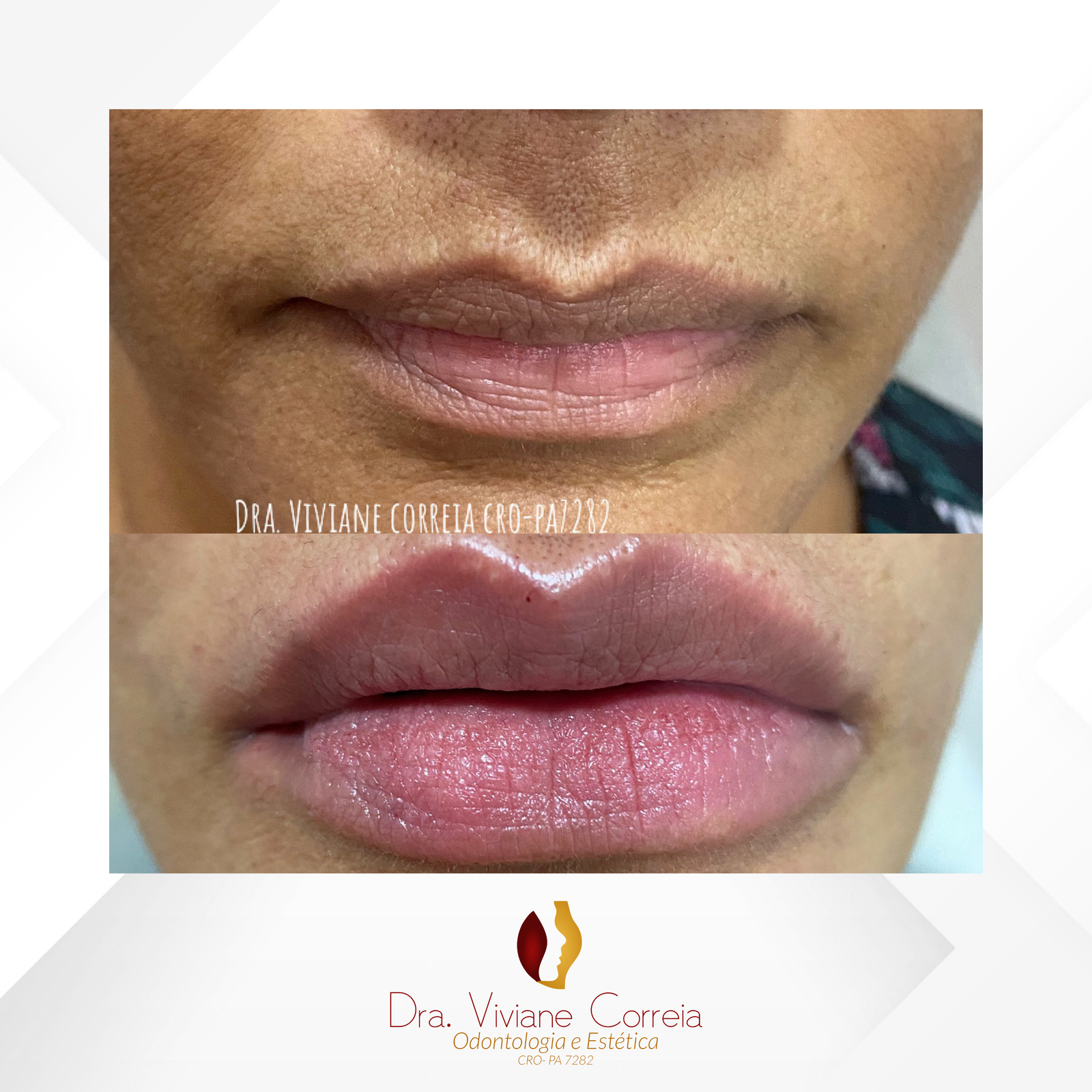 Dra. Viviane Correia Preenchimento Labial #10.1