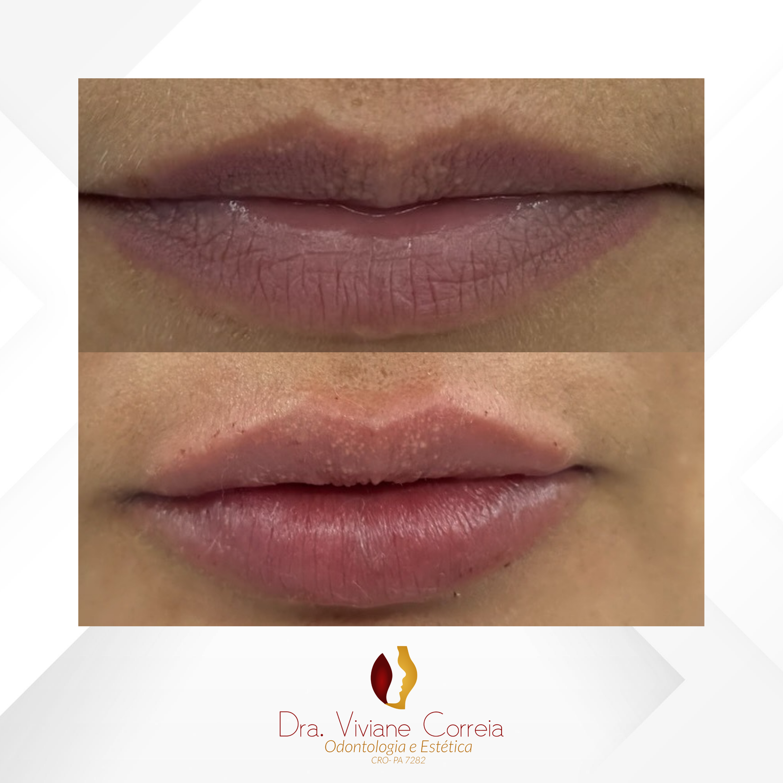 Dra. Viviane Correia Preenchimento Labial #12.1