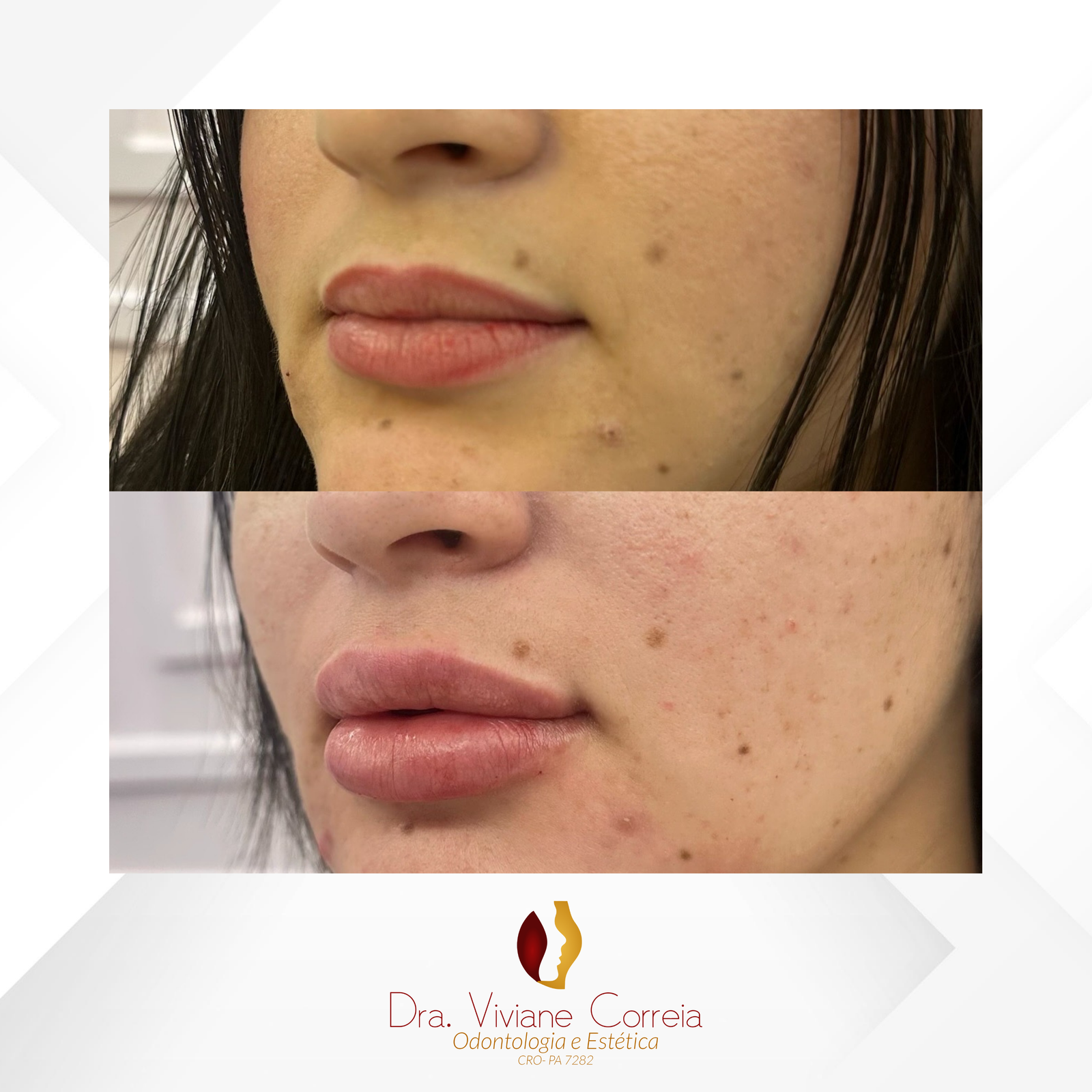 Dra. Viviane Correia Preenchimento Labial #13.1