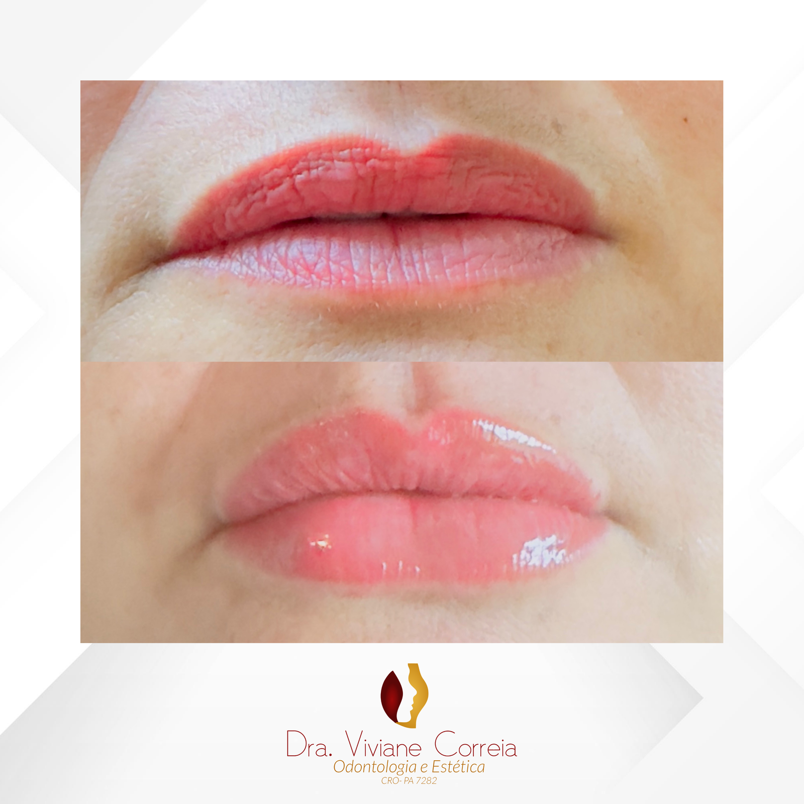 Dra. Viviane Correia Preenchimento Labial #14.1