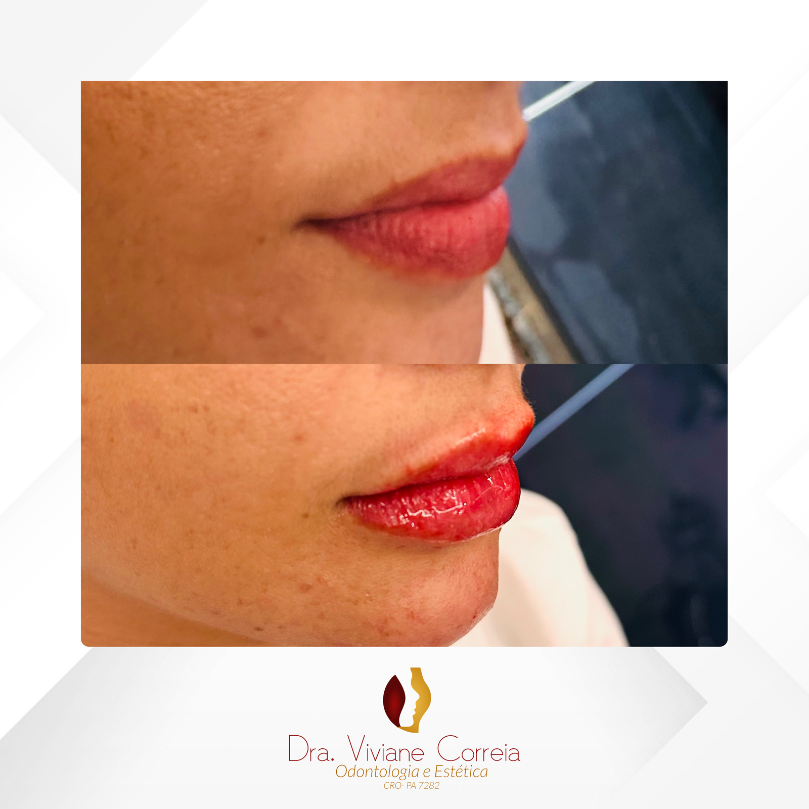 Dra. Viviane Correia Preenchimento Labial #15.1