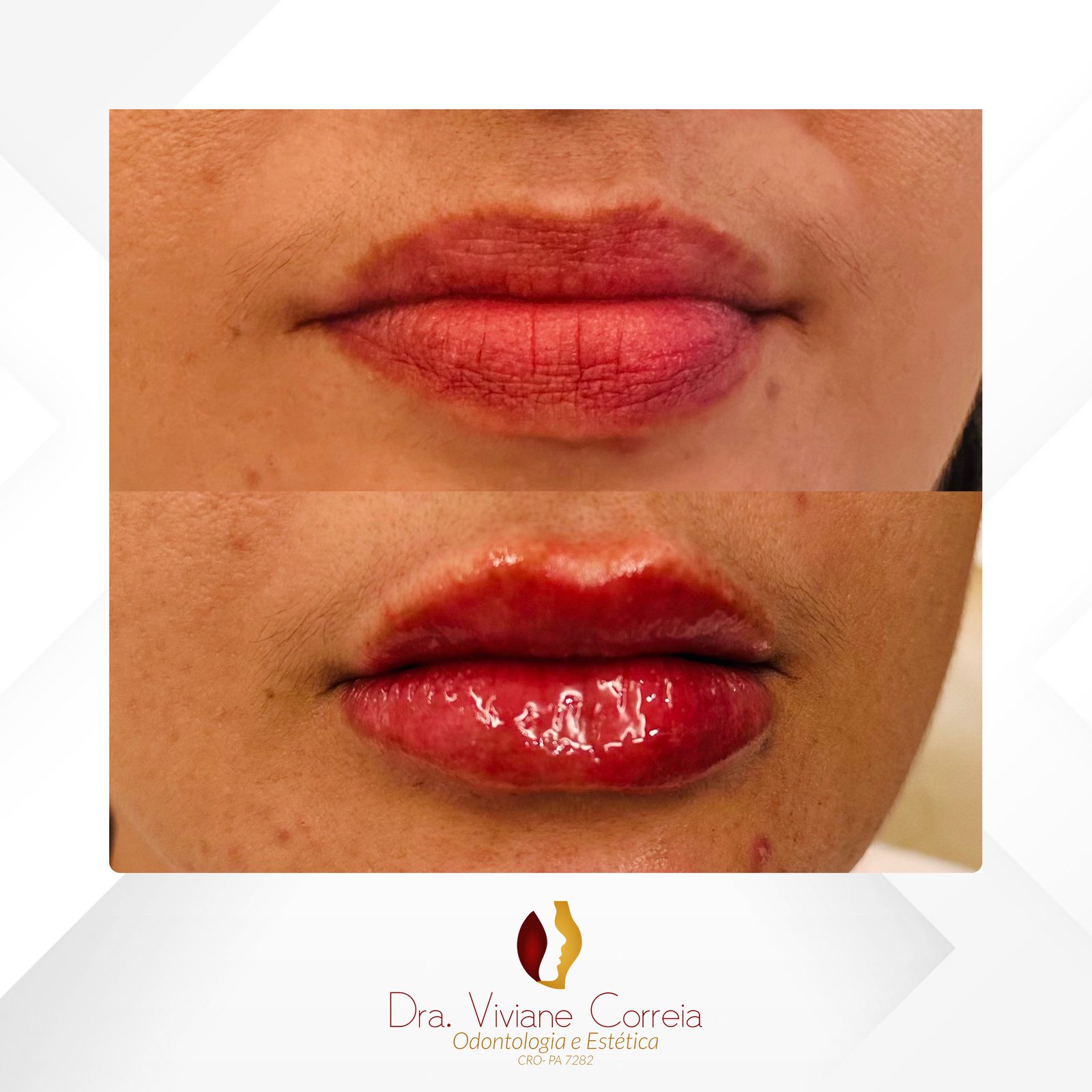 Dra. Viviane Correia Preenchimento Labial #16.1