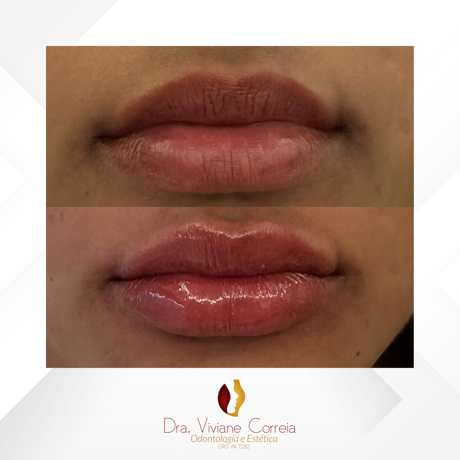 Dra. Viviane Correia Preenchimento Labial #17.1