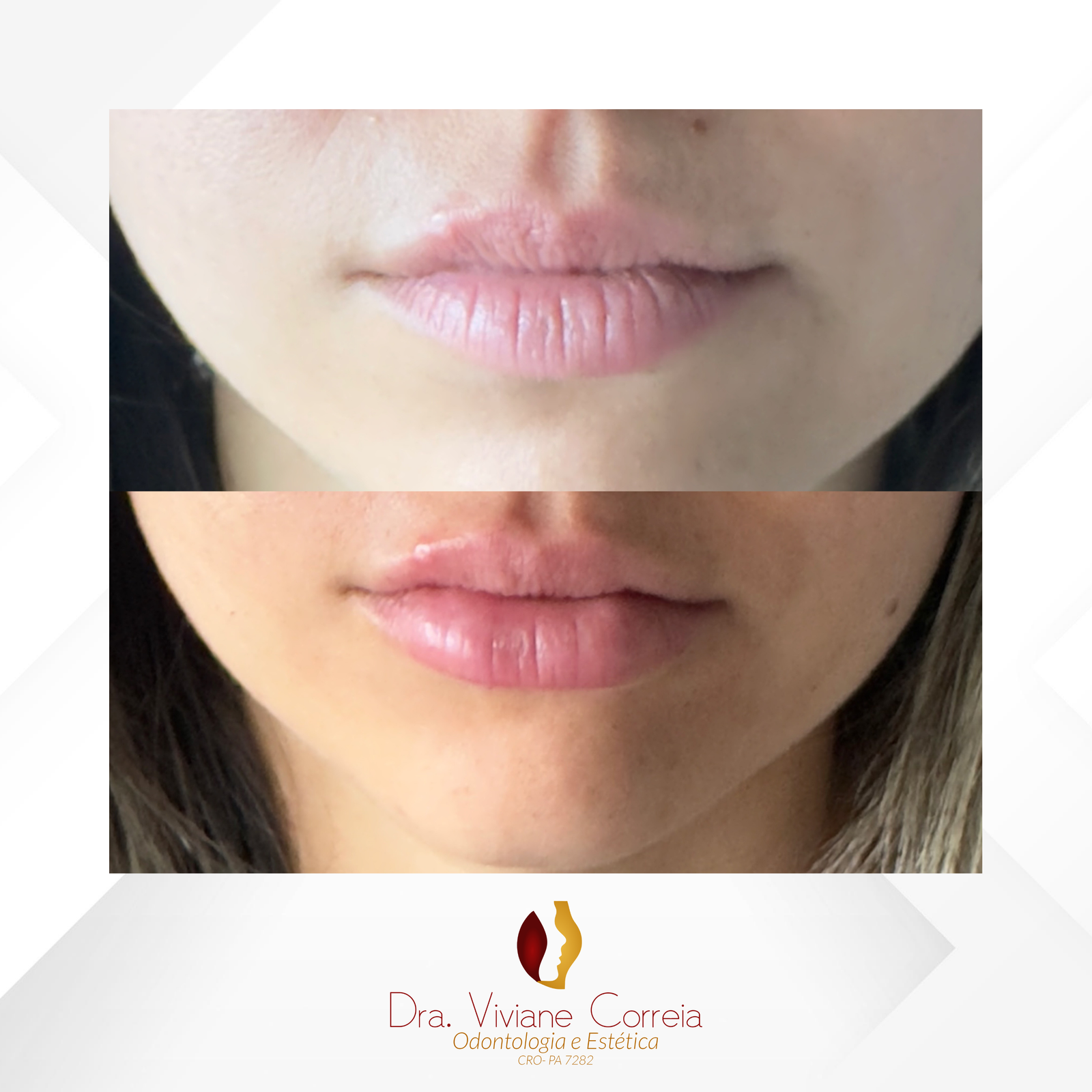 Dra. Viviane Correia Preenchimento Labial #18.1