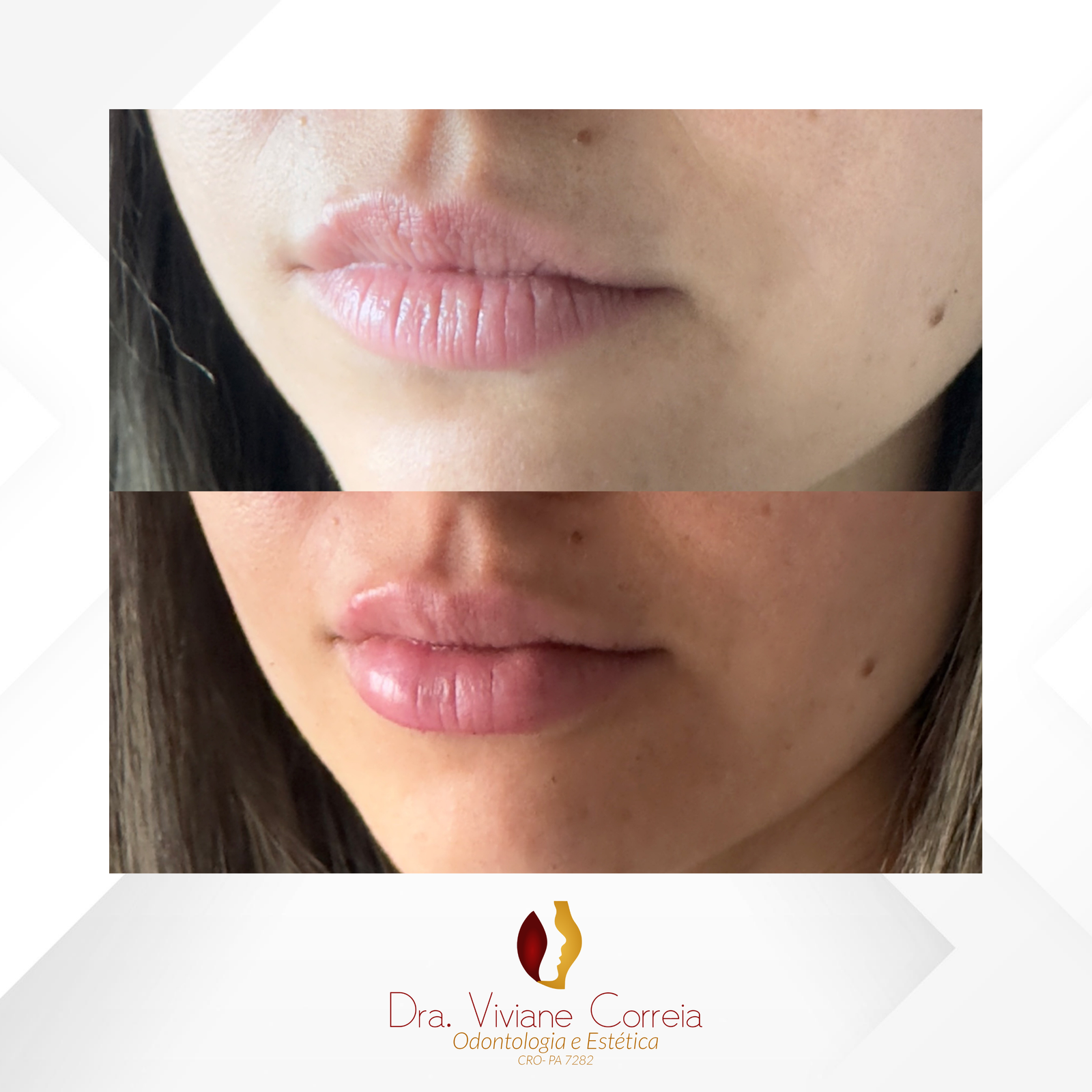 Dra. Viviane Correia Preenchimento Labial #19.1