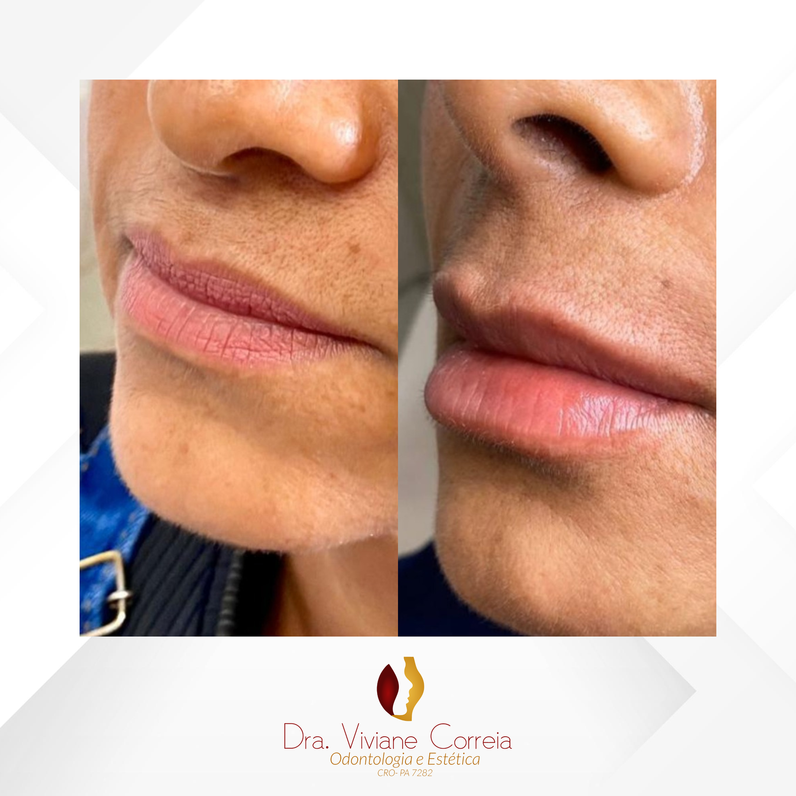 Dra. Viviane Correia Preenchimento Labial #2.1