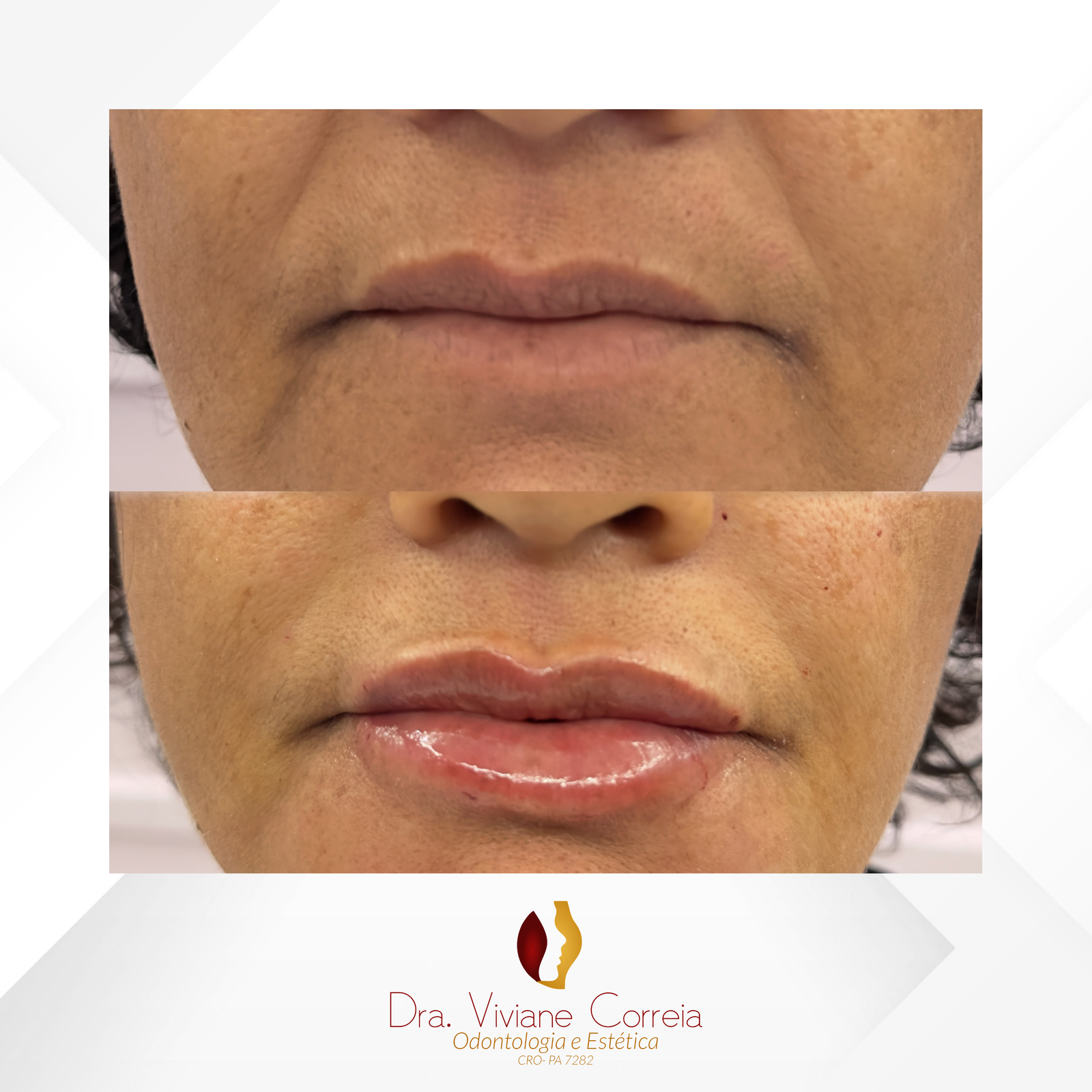 Dra. Viviane Correia Preenchimento Labial #20.1
