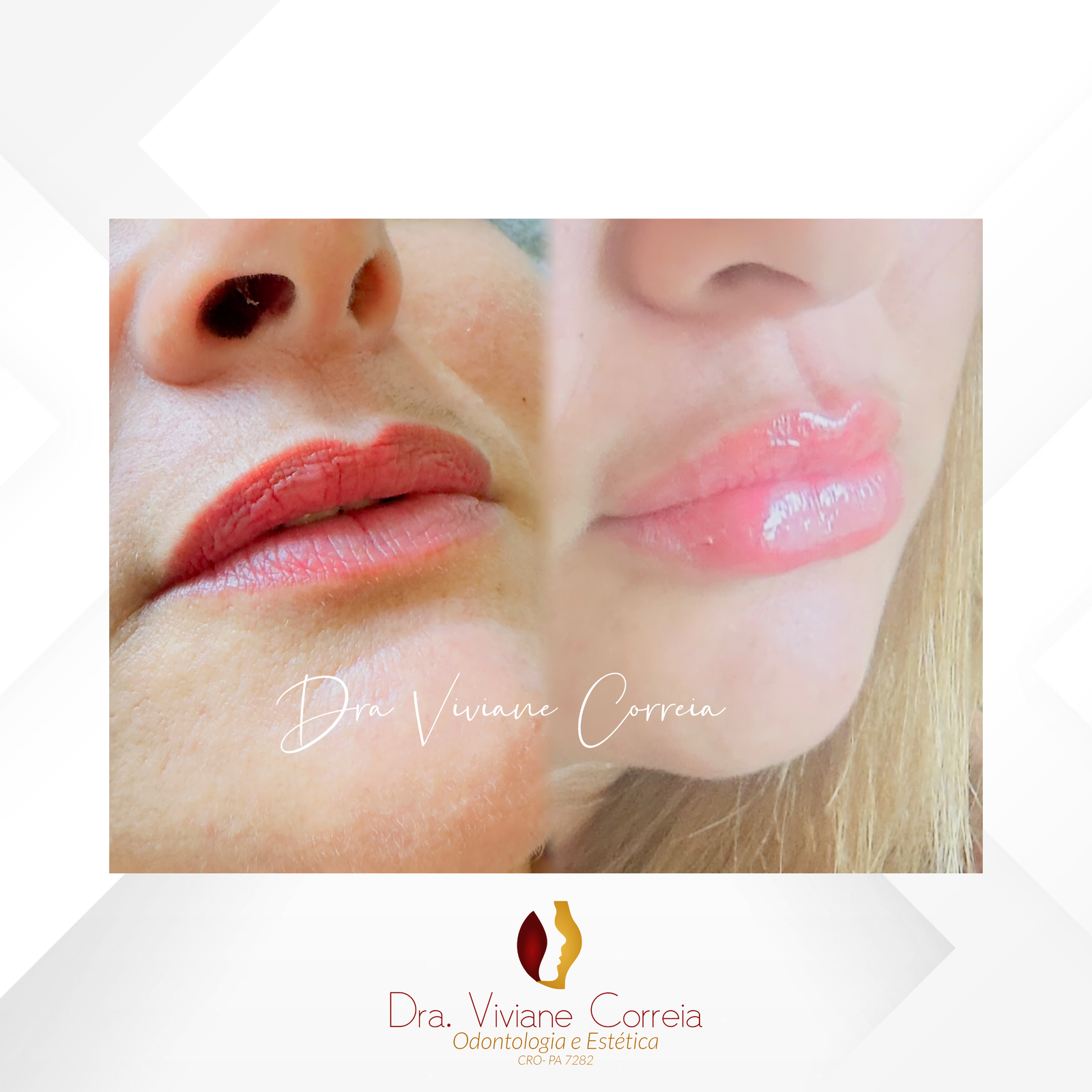 Dra. Viviane Correia Preenchimento Labial #3.1