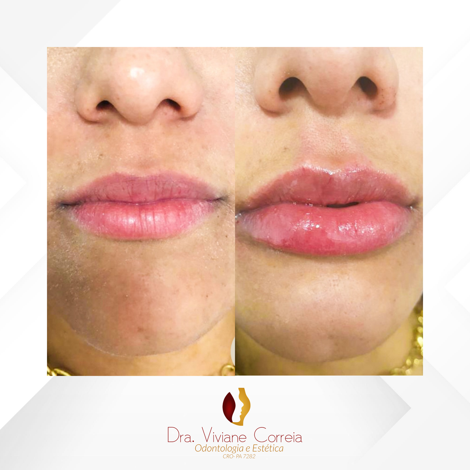 Dra. Viviane Correia Preenchimento Labial #4.1