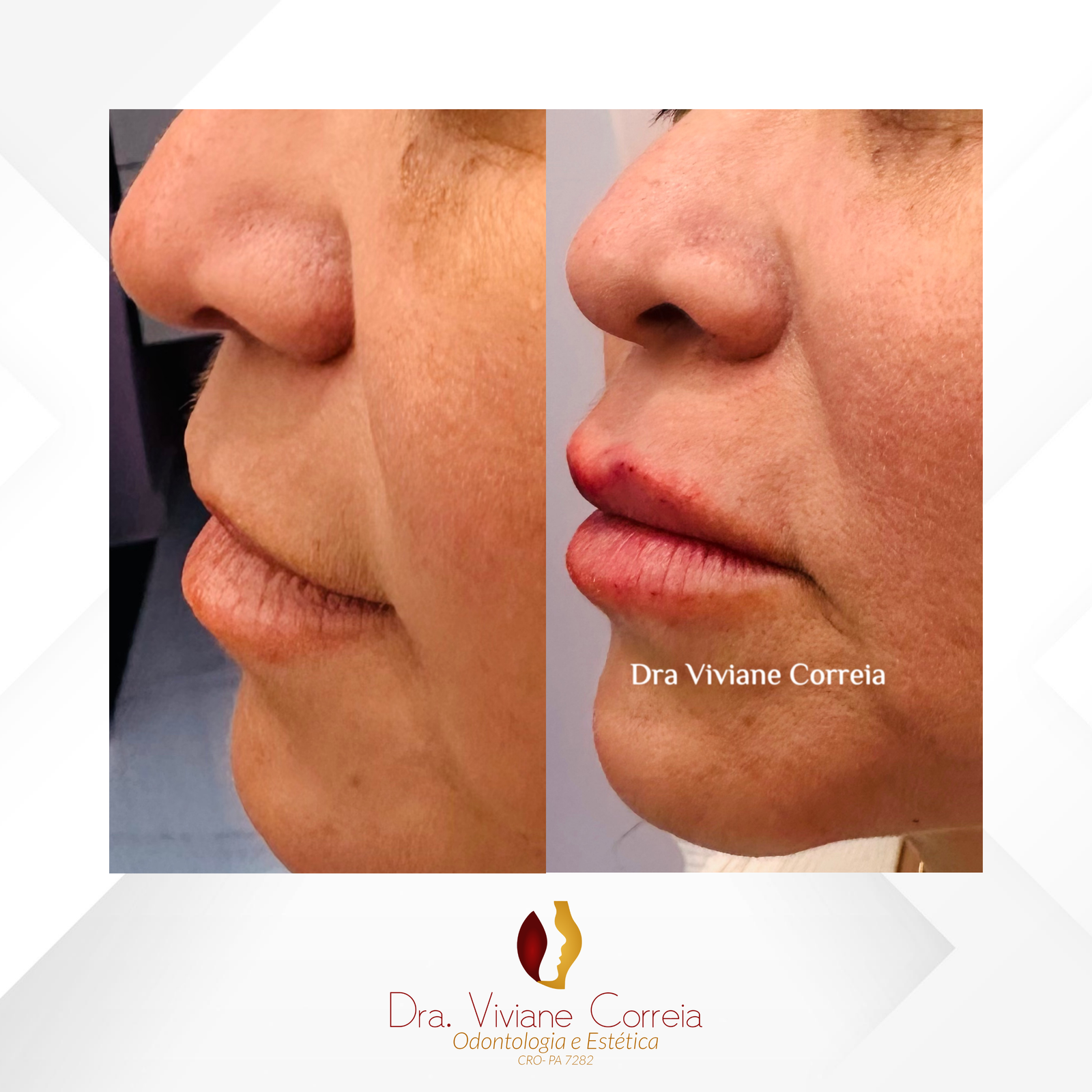 Dra. Viviane Correia Preenchimento Labial #5.1
