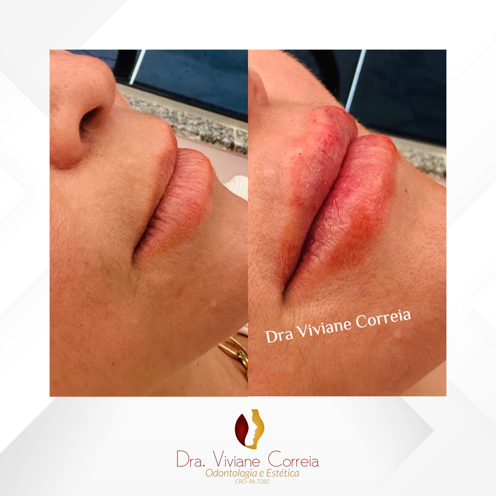Dra. Viviane Correia Preenchimento Labial #6.1
