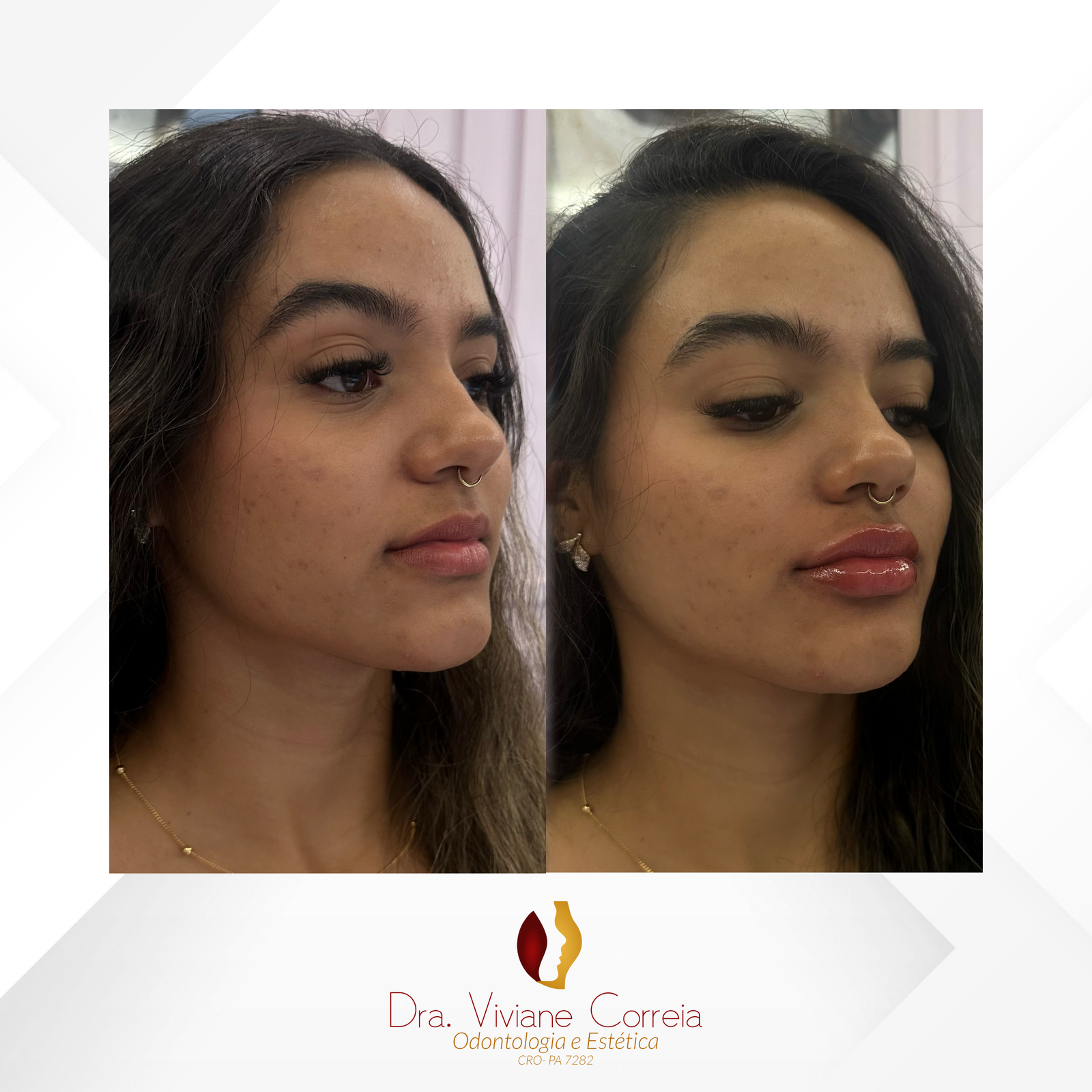 Dra. Viviane Correia Preenchimento Labial #7.1