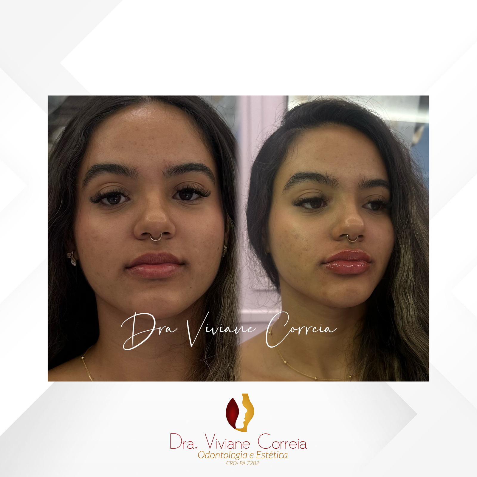 Dra. Viviane Correia Preenchimento Labial #8.1