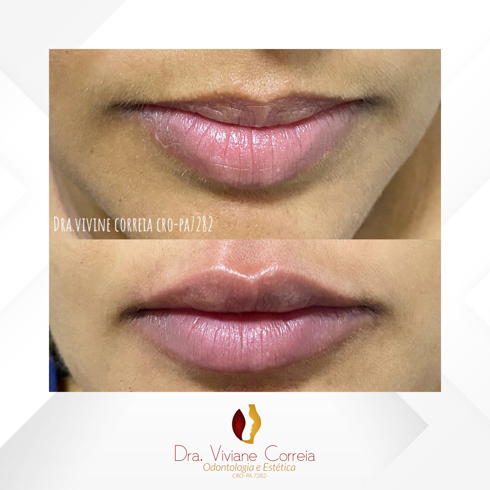 Dra. Viviane Correia Preenchimento Labial #9.1