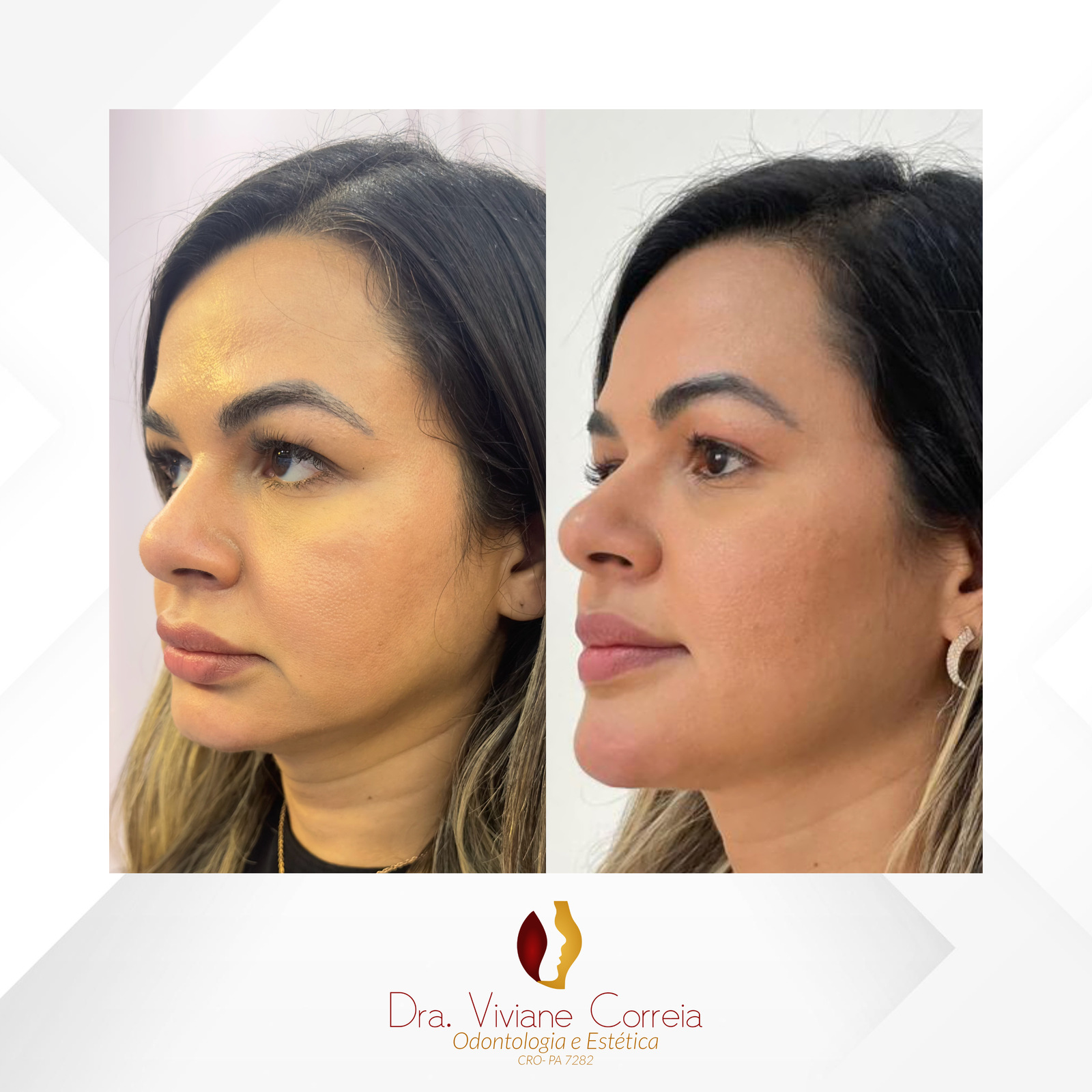 Dra. Viviane Correia Preenchimento do Mento (Queixo) #4.1